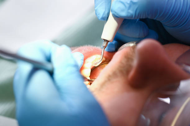 Best Emergency Wisdom Teeth Removal in Central City, KY