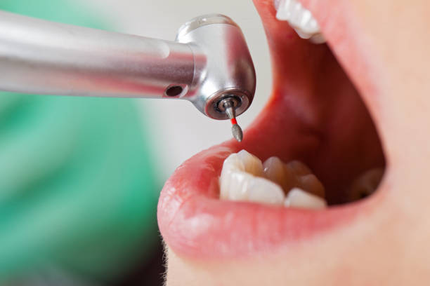 Best Emergency Tooth Extraction in Central City, KY